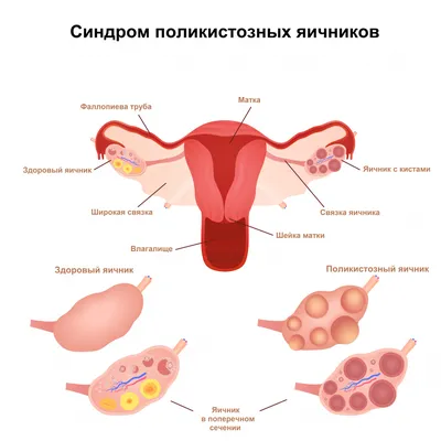 Киста яичника симптомы, диагностика и лечение | Причины возникновения и  признаки кисты