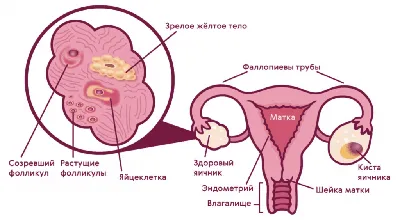 кисты обоих яичников - Киста и кистома яичника – вопрос специалисту №2 -  Гинекологический форум