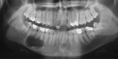 Киста зуба: как выглядит, как проявляется. 🦷 Киста корня зуба: как быть  после кисты зуба