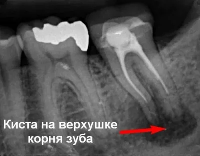 Чем опасна киста корня зуба? | TopDent | Дзен