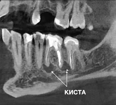 Киста зуба – чем опасна, симптомы, как выглядит