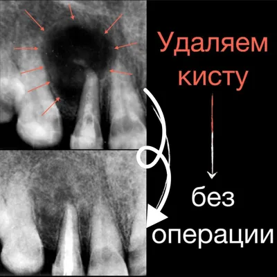 Лечение зубов под микроскопом, лечение каналов зуба цена Бровары Киев