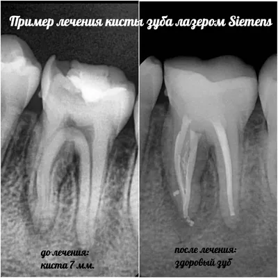 Киста зуба [симптомы, методы лечение, как выглядит, причины]