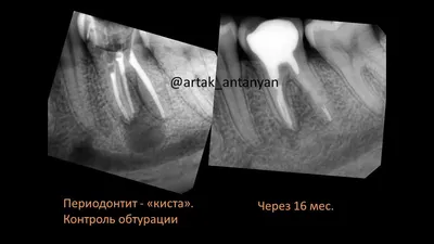 Лечение кисты зуба: стоимость в Москве, фото услуги, отзывы
