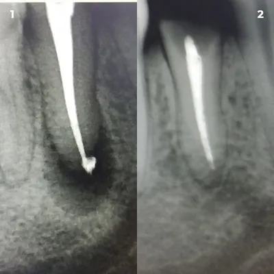 Клинический случай 1 зубной канал | Стоматологическая клиника Оланко каналы  1 Оланко™