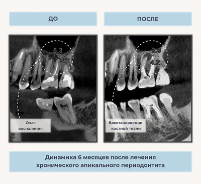 Удалить кисту зуба, проросшую в пазуху у Dr.Полетаева А.Л.