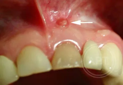 Киста зуба: причины, симптомы, правильное лечение — D.Ante