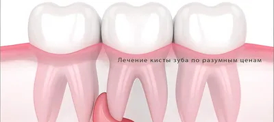 Киста зуба [симптомы, методы лечение, как выглядит, причины]