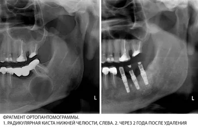 Киста зуба и все, что должен знать пациент стоматолога в Харькове