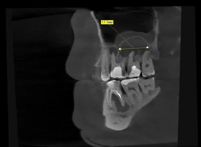 Киста зуба | Блог | Стоматология Eurodental