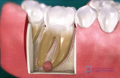 Киста, гранулёма зуба - Стоматологическая клиника Дентсервис
