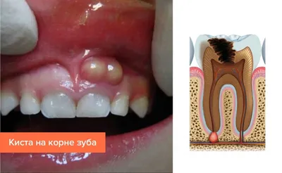 Киста зуба и все, что должен знать пациент стоматолога в Харькове
