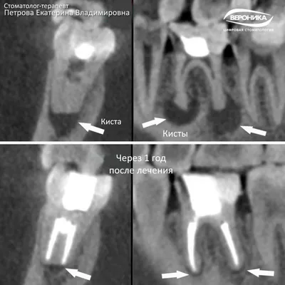 Что нужно знать о кисте зуба? Реальные фото | Стоматология Smile-at-Once |  Дзен