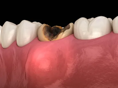 Киста зуба - что это, причины кисты зуба, стадии, симптомы, виды и лечение  кисты