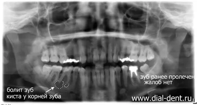 Костная пластика с удалением кисты - SinusLifting.ru