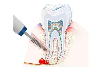 Что нужно знать о кисте зуба? Реальные фото | Стоматология Smile-at-Once |  Дзен