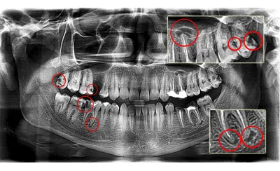 Киста после удаления зуба: кто виноват и как лечить заболевание | Dental Art