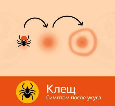 Что делать, если укусил клещ? - ГБУЗ СО \"Детская городская больница г.  Нижний Тагил\"