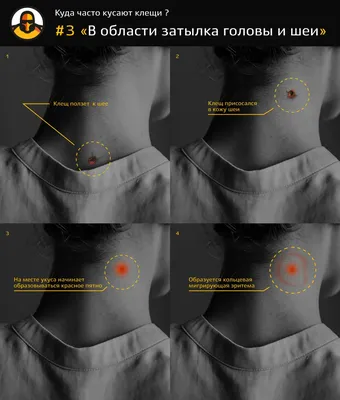 Укусы клопов, как выглядят?Подробное описание и фотографии