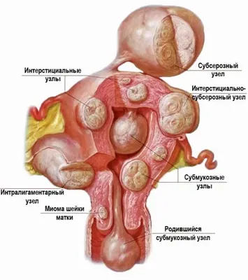 Эндометриоз при климаксе (в менопаузе): симптомы, лечение, проходит ли