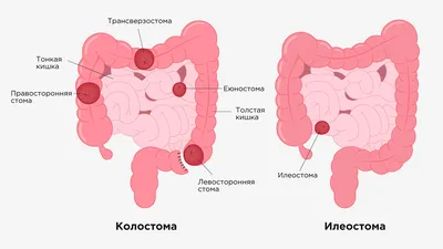 Колостома: что это, показания, виды, подготовка к операции