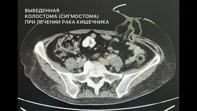 Онко Вики — Что такое стома? Кому она показана?