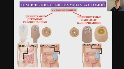 Основные сведения о стоме: колостома, илеостома или уростома