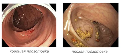 Однокомпонентный дренируемый калоприемник Alterna нового поколения |  Coloplast