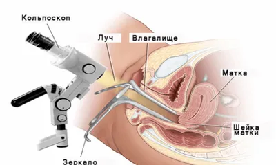 ➡️ Кольпит, симптомы и лечение, причины заболевания у женщин - клиника  Девита (Devita)
