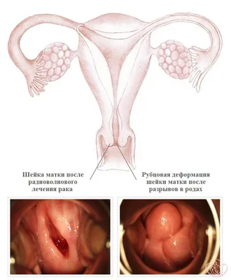 Зачем нужна кольпоскопия? | Пикабу
