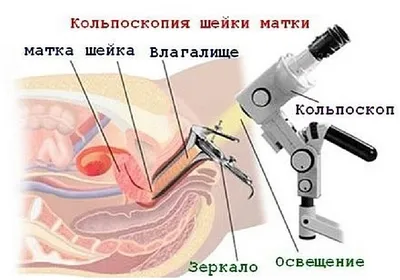 Кольпоскопия