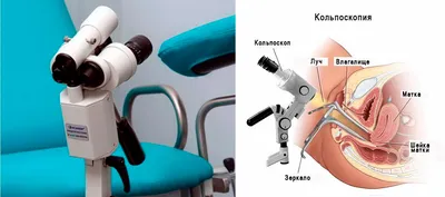 Расширенная кольпоскопия шейки матки - сделать в Одессе