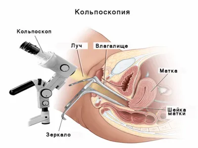 Кольпоскопия — это больно? Нет! | Черновик