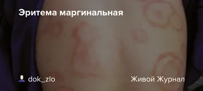 Микоз гладкой кожи? Кольцевидная эритема? - Форум