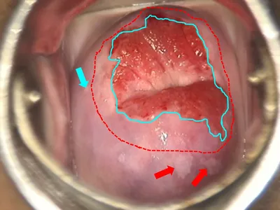 Atlas of visual inspection of the cervix with acetic acid for screening,  triage, and assessment for treatment