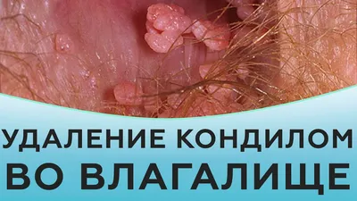 Удаление кондилом: удалить кондиломы в клинике СПб, цены