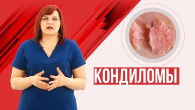 Удаление кондилом, папиллом БЕЗ БОЛИ в Пятигорске | Курортная клиника  женского здоровья