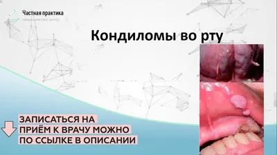 Крем для удаления кондилом МБНПК \"Цитомед\" Вартоцид - «Отзыв об удалении  кондиломы кремом Вартоцид в домашних условиях и фото» | отзывы