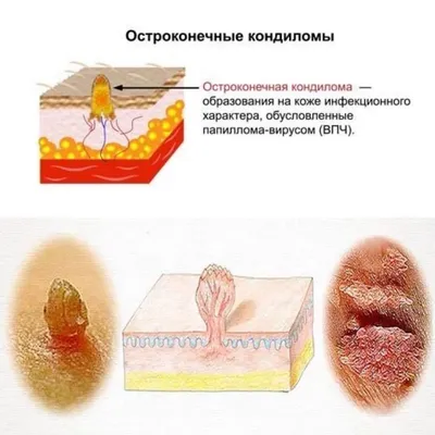 Удаление кондилом в Москве - Damas Medical Center