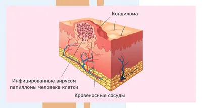 ВПЧ - папилломы, остроконечные и широкие кондиломы. Удаление и лечение  папиллом.