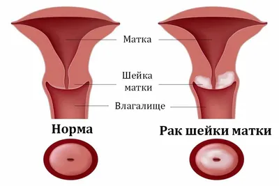 ПАПИЛЛОМЫ, КОНДИЛОМЫ, БОРОДАВКИ И ДРУГИЕ НАРОСТЫ КОЖИ · Оптисалт Казахстан