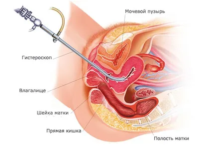 Современные методы лечения остроконечных кондилом полового члена – тема  научной статьи по клинической медицине читайте бесплатно текст  научно-исследовательской работы в электронной библиотеке КиберЛенинка