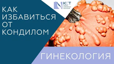 Остроконечные кондиломы: причины появления, диагностика и лечение  проявлений ВПЧ