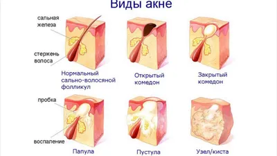 Уход за проблемной кожей: угревая болезнь и методы ее лечения