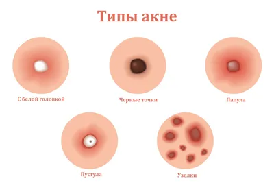 Лечение угревой сыпи всех видов сложности: -конглобатное акне -розацеа  -подростковые угри и прыщи -угревая сыпь на теле и лице… | Instagram