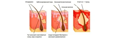 Прыщи на теле: причины, лечение, удаление, виды прыщей на лице