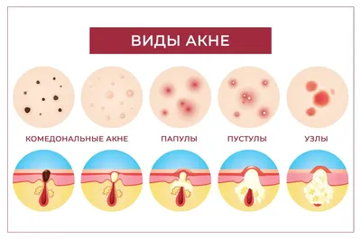 Они вернулись: 15 глупых вопросов о прыщах | Enter