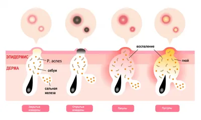 Что такое акне, как его лечить | Централ Клиник