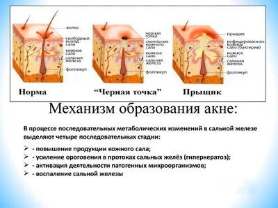 Давить прыщи можно? Акне – это навсегда? Угревая сыпь может появиться в 30  лет? Дерматолог отвечает на популярные вопросы про акне - CityDog.io