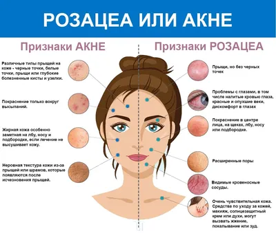 Как избавиться от угрей: вылечить прыщи на лице навсегда, народные средства  от угрей